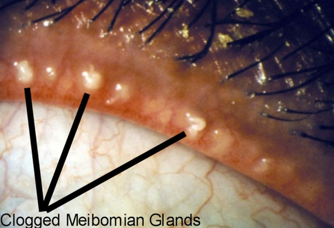 Blocked eyelid oil gland: clogged meibomian glands obstructing the secretion of oil resulting in a stye. 