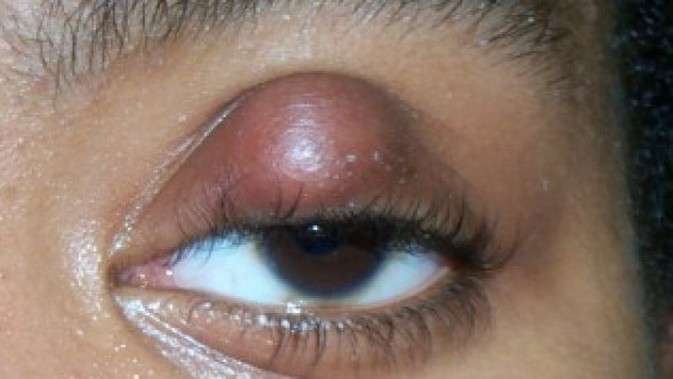 What causes red eyelids?