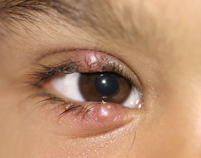 Medical care given to treat a patient for a stye should be given promptly. Therapy should consist of antibiotic medication, and administered until the drug has cured the stye. 