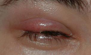 Does a stye cause redness and swelling? Does a stye look like a whitehead pimple?