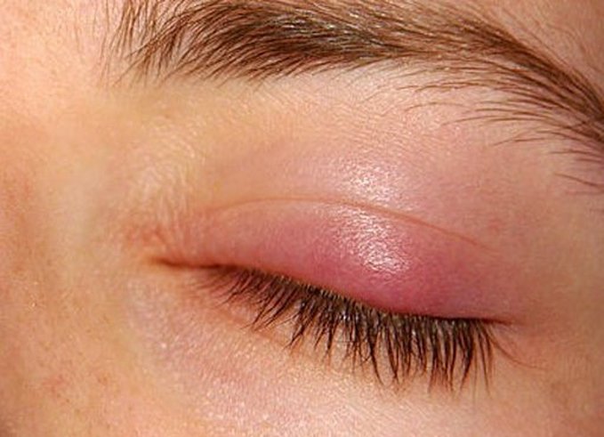 Picture of Internal stye one or two days old on upper eyelid. Eyelid swelling usually increases severly after 2 days. 