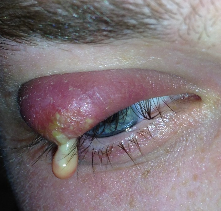 How To Get Rid Of A Chalazion Fast Cyst Boil Abscess