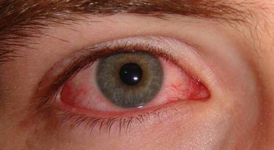 Looking at or reading from a display screen for a prolonged, uninterrupted period of time can cause eye styes, also known as a hordeolum. Which is a inflamed swelling caused by blockage of an eyelid oil gland. 