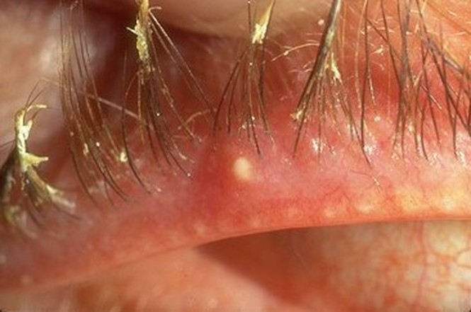 Hordeoloum (Stye) causes crusting, excessive discharge, mucus on eyelid margins and eyelashes.