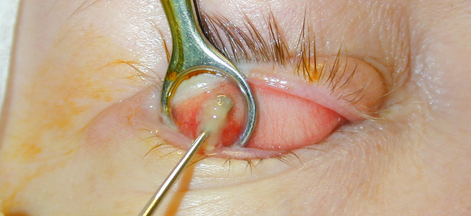 do chalazion on the inside of the eyelid need to be lanced how to lance an eye boil or cyst