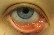 Stye picture of boil containing accumulation of yellow pus. 