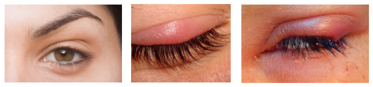 Pain in eye when blinking (possible eye stye)