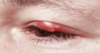 External sty positioned on the outer surface of the top eyelid, white dot like pimple. 