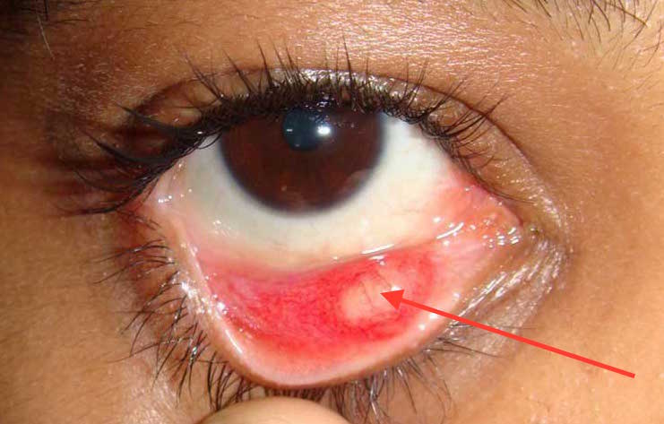 how to get rid of a chalazion overnight will warm water compress break a chalazion 