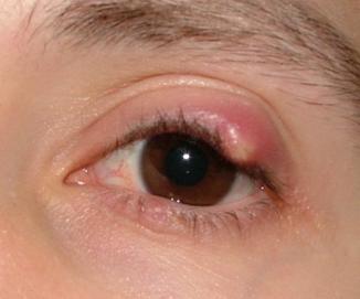 the chalazion in my eye popped know my eye is swollen oozing yellow pus