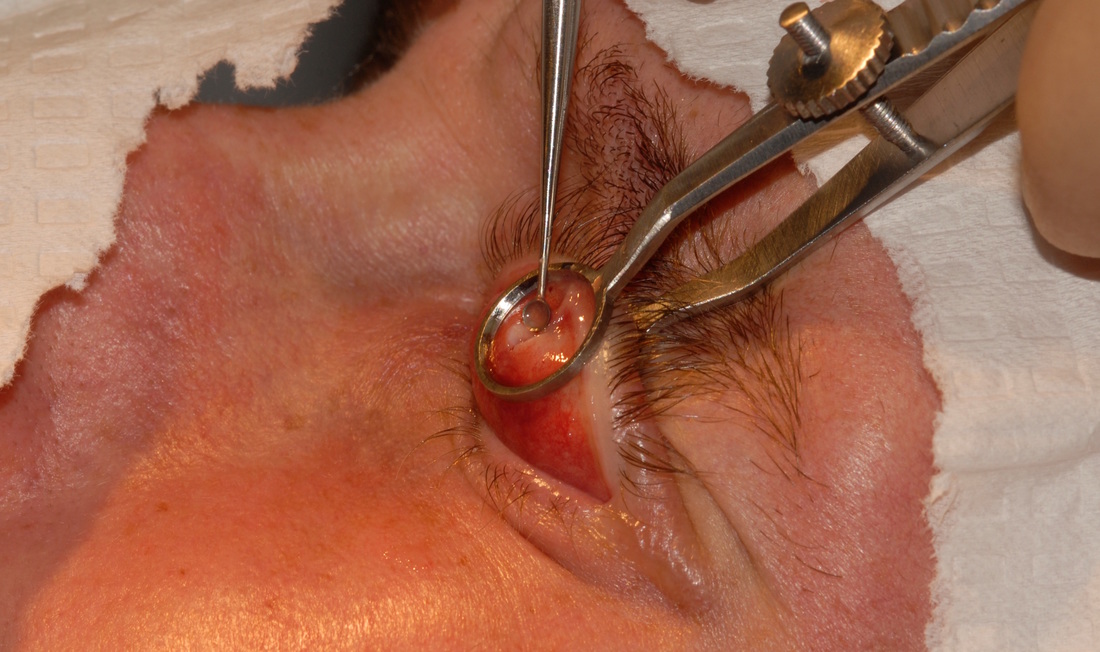 eyelid pimple surgery, eye surgery for internal stye, cyst chalazion and boil