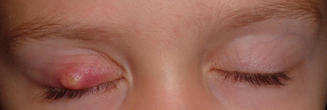 Recurring styes happening again, inflamed swelling on edge of eyelid