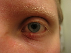 An external stye (eye sty) forms own the outer surface of the eyelid, just below the skin, resembling a pimple or red bump. 