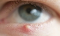 Does a stye look like a red bump or pimple on the eye?