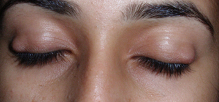 A stye, also known as sty or hordeolum, is an inflamed swelling caused by bacterial infection of the gland on the edge of an eyelid. The bump is red and painful, resembling a pimple or boil. 
