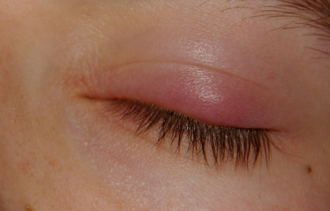 What is the first sign or symptom of a stye in the eye? Symptoms include redness, swelling, eyelid pain, and a bump. 